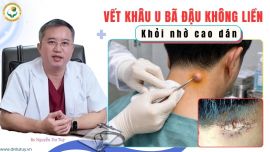 Xử Lý Vết Khâu U Bã Đậu Không Liền, Toác Rộng Bằng Cao Dán Dr. Dư Tuy