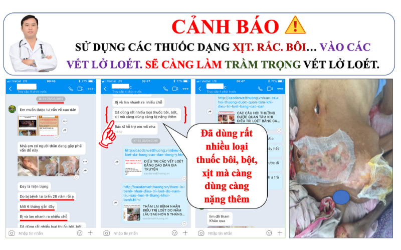 Xử lyws vết thương hoại tử