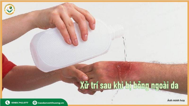 xu-tri-sau-khi-bi-bong-ngoai-da