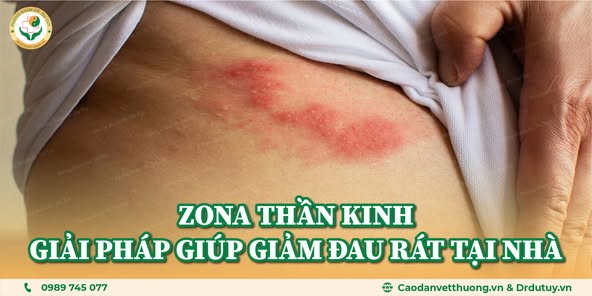 zona-than-kinh-nguyen-nhan-trieu-chung-cach-phong-tranh-va-dieu-tri-hieu-qua-tai-nha