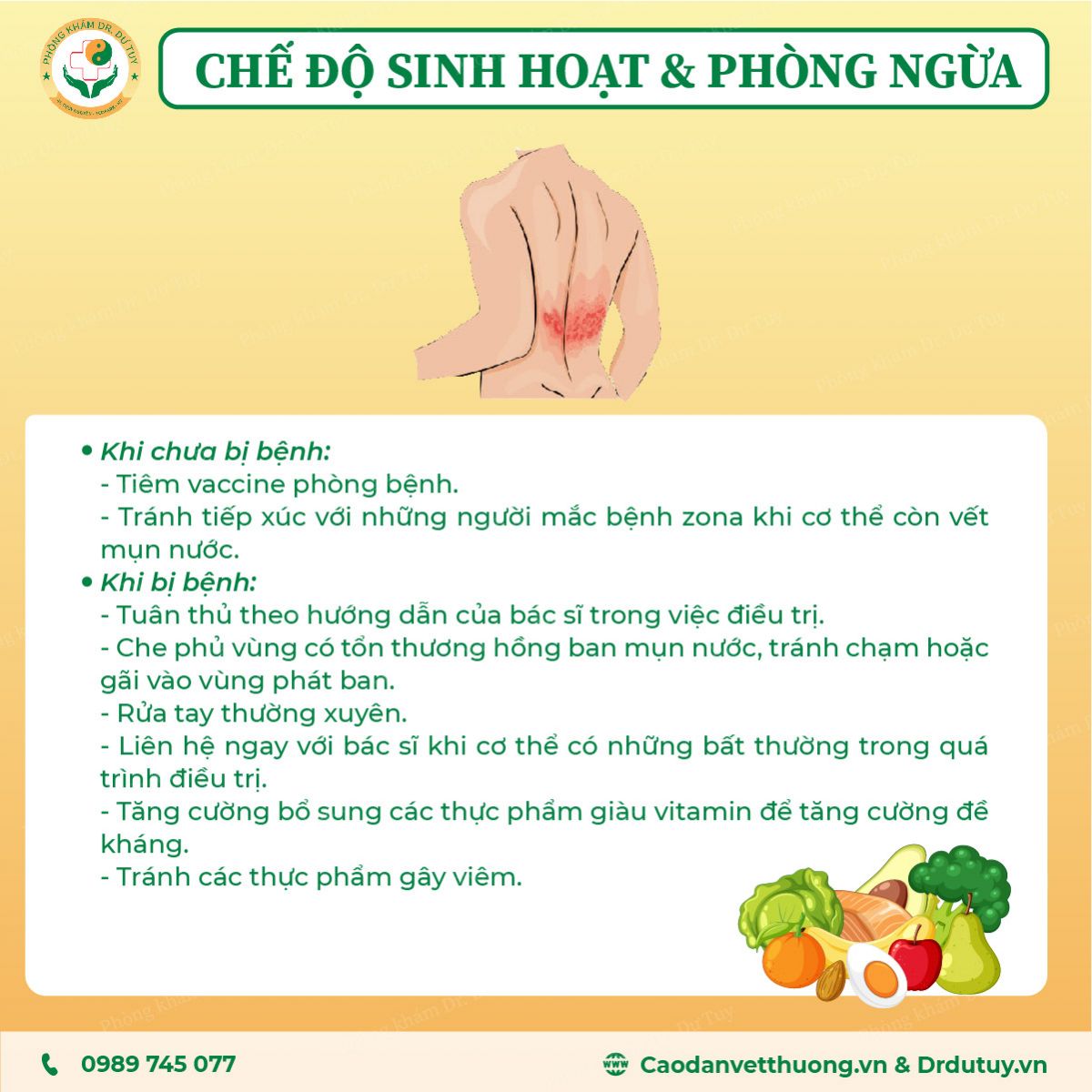 zona-than-kinh-nguyen-nhan-trieu-chung-cach-phong-tranh-va-dieu-tri-hieu-qua-tai-nha4