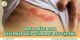Zona Thần Kinh: Nguyên Nhân, Triệu Chứng, Cách Phòng Tránh Và Điều Trị Hiệu Quả Tại Nhà